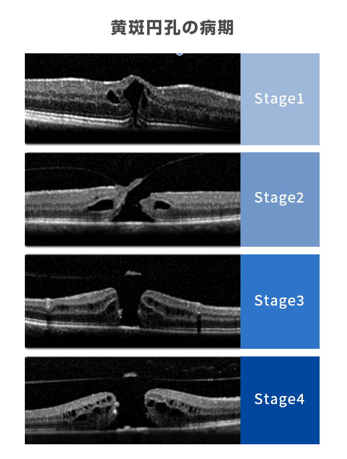 黄斑円孔病期
