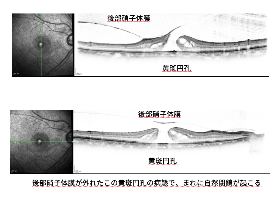 黄斑円孔病期