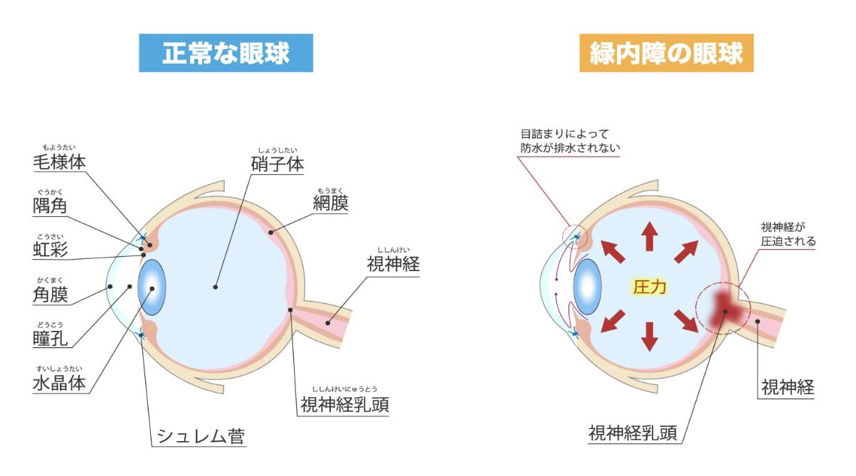 緑内障詳細図