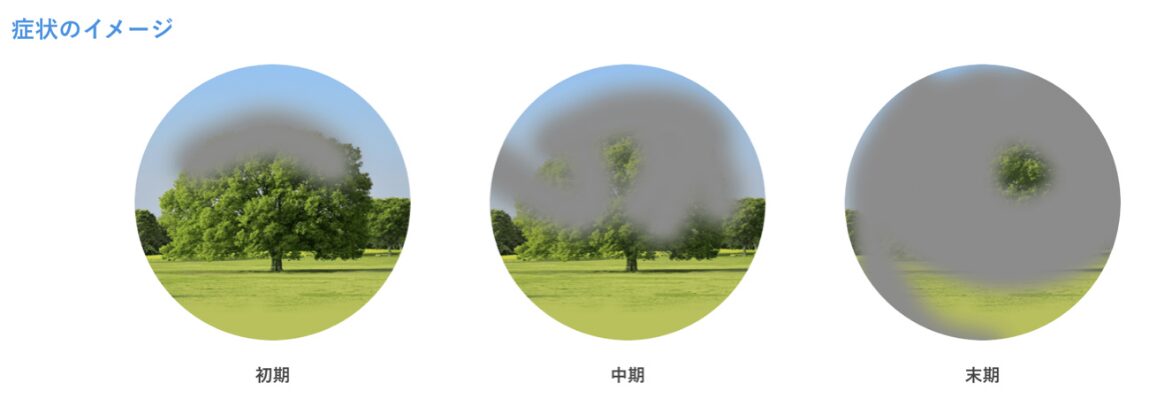 緑内障症状イメージ図