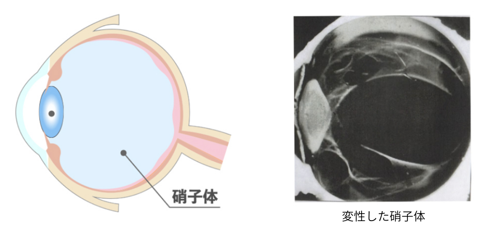 硝子体症状イメージ図