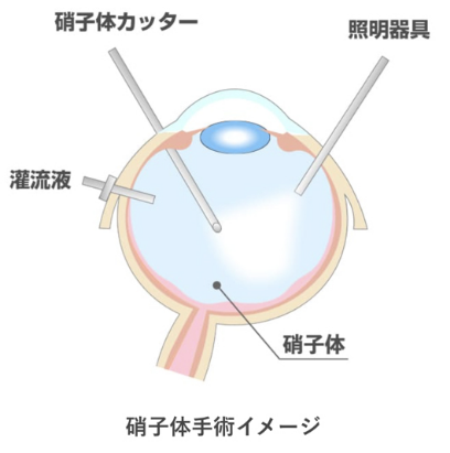 硝子体手術イメージ図
