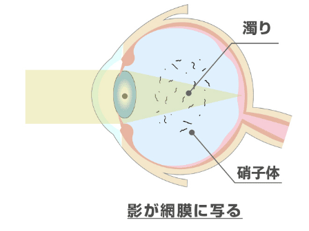 飛蚊症症状イメージ図