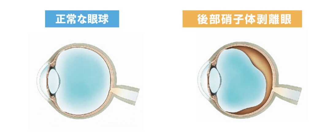 飛蚊症症状イメージ