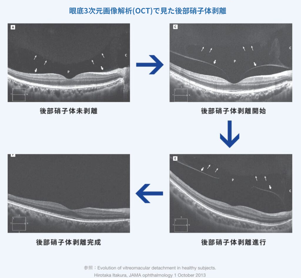 眼底3次元画像分析で見た後部硝子体剥離