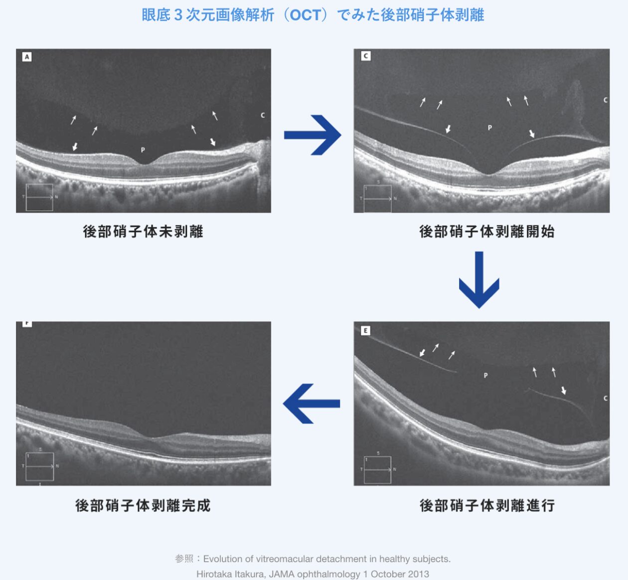 眼底3次元画像解析（OCT）でみた後部硝子体剥離解析図