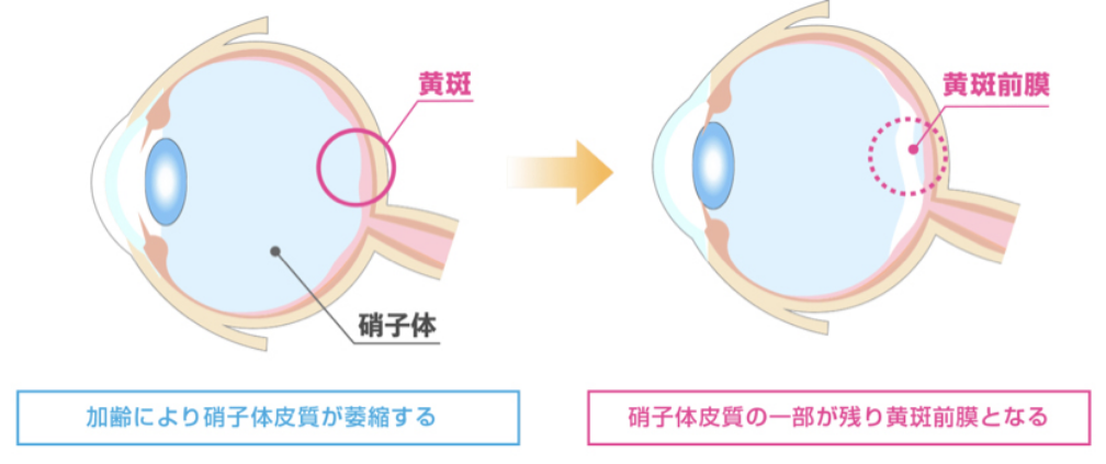 黄斑前膜症状イメージ図