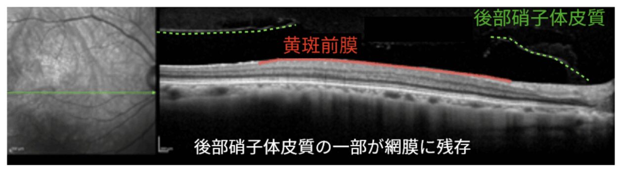 黄斑前膜症状イメージ