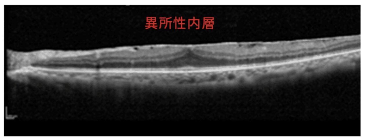 網膜の外層構造イメージ